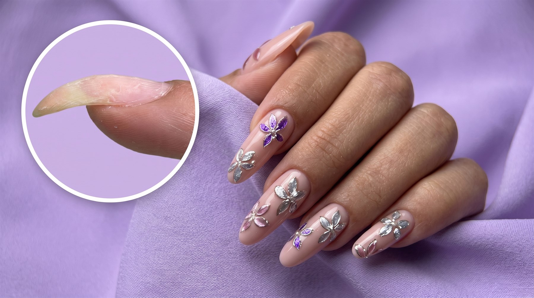 הרמת ציפורן נשרית · Nail UP